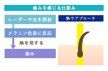 脱毛が痛い理由