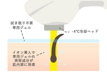 イオン導入同時照射(特許 第6707234号)